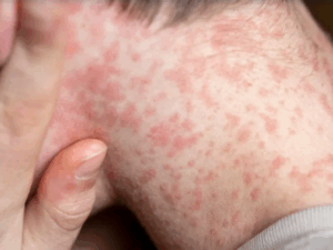 Measles A close up of measles on a child's neck.